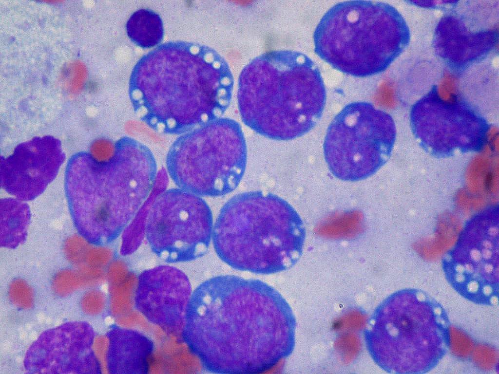 Especialistas cuestionan las “dietas milagro” frente al cáncer y recuerdan el peso de la obesidad como factor de riesgo