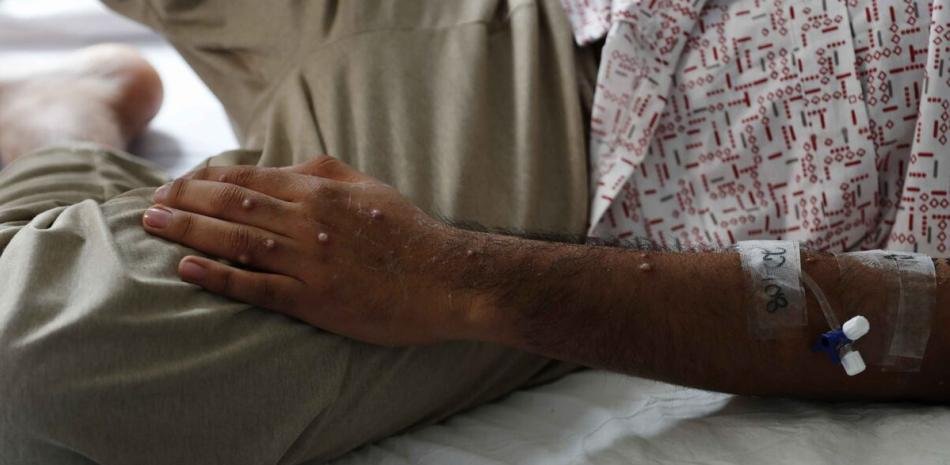 San Cristóbal: Salud confirma dos casos de viruela símica y mantiene bajo revisión otros siete